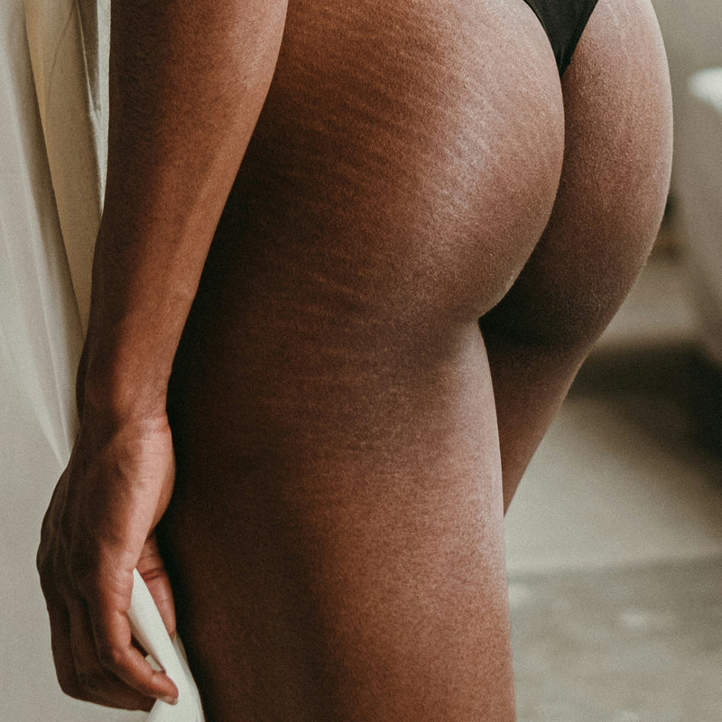 HOW TO TREAT AND PREVENT STRETCH MARKS