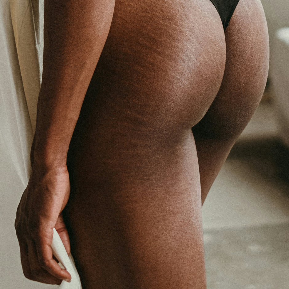 HOW TO TREAT AND PREVENT STRETCH MARKS